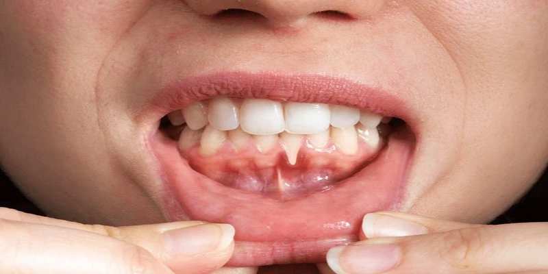 ما هي التوابع السلبية الناتجة عن تبييض الأسنان بشكل خاطئ؟