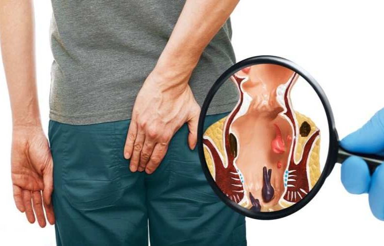 أخطاء شائعة تؤدي إلى فشل علاج البواسير