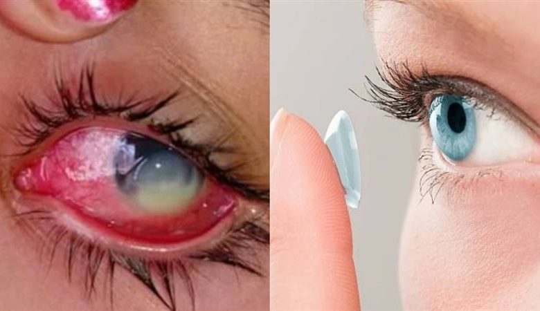 أضرار العدسات اللاصقة على صحة العينين