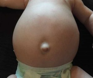 أعراض الورم في البطن