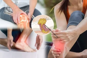 ارتفاع حمض اليوريك في أجسام النساء