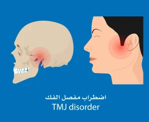 اضطراب المفصل الصدغي الفكي