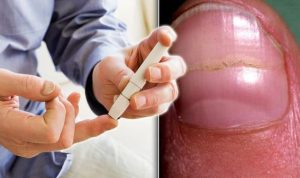 تكرار حدوث الإصابة بالفطريات