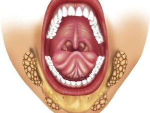 حصوات الغدد اللعابية