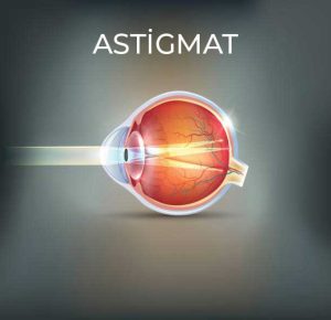 عدسات تصحيح الاستجماتيزم