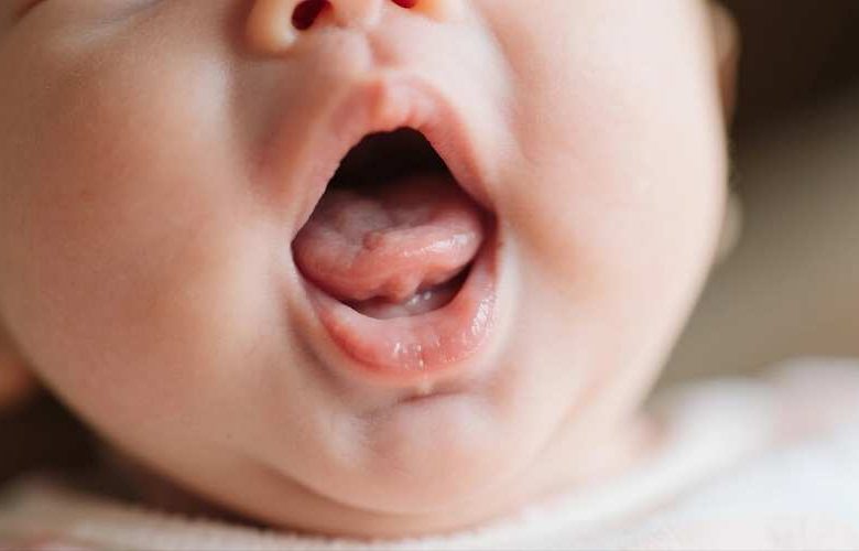 ما مدى معاناة الأطفال من أزمة ربط اللسان؟