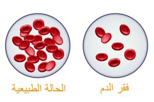 أفضل روتين علاجي لمشكلة الأنيميا