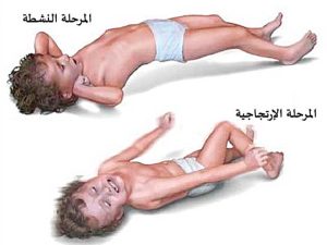 الأعراض الشائعة لمتلازمة ويست لدى الرضع