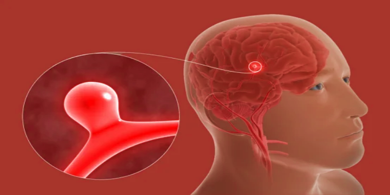 تمدد الأوعية الدموية الدماغية