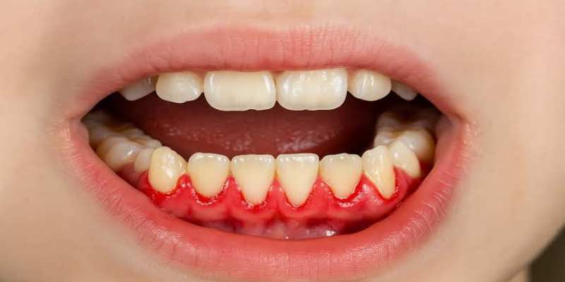 عواقب التهاب دواعم السن