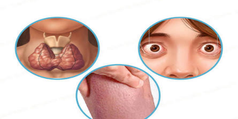 كيف يتم علاج مرض جريفز؟