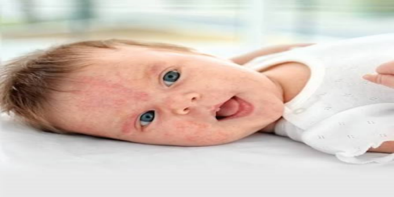 ما هي أعراض حساسية الحليب عند الأطفال؟