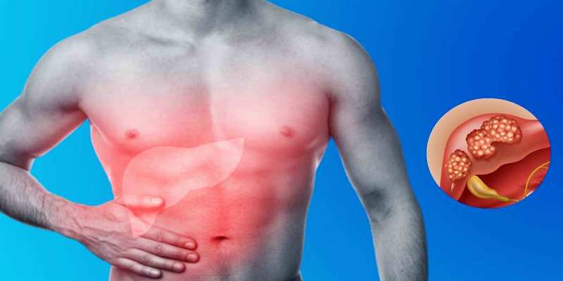 ما هي الآلية السليمة للعمل على إدارة أورام الكبد الحميدة؟