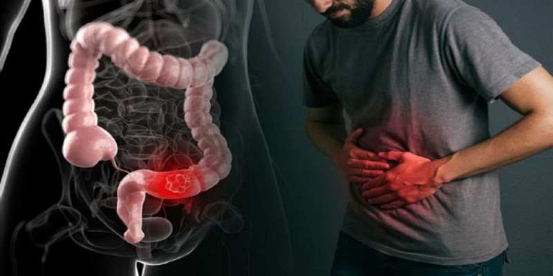 ما هي توابع تطور حالة سلائل القولون؟