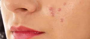 نتوءات جلدية شائعة تظهر على وجهك