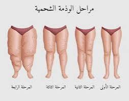 4 مراحل خاصة بالليبيديما