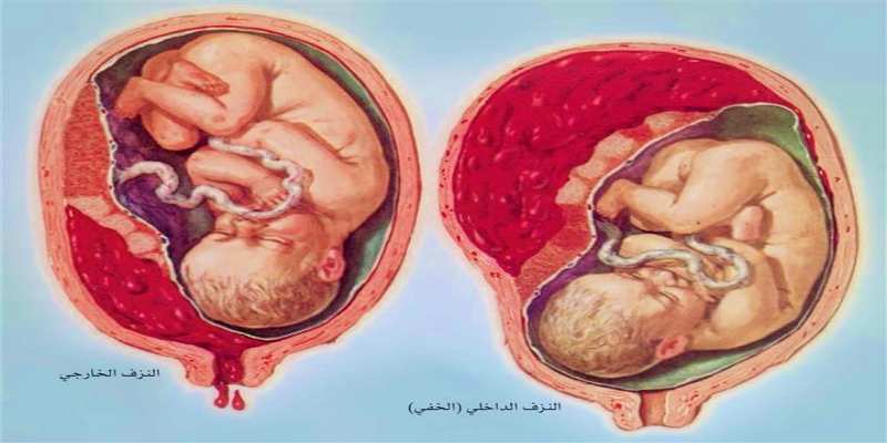 أنواع انفصال المشيمة