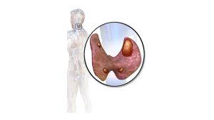 اضطرابات الغدة الجار درقية