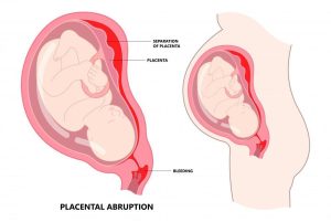 التجمع الدموي حول كيس الحمل