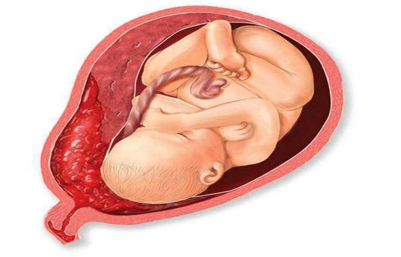 المرأة الحامل ومخاطر الإصابة بانفصال المشيمة