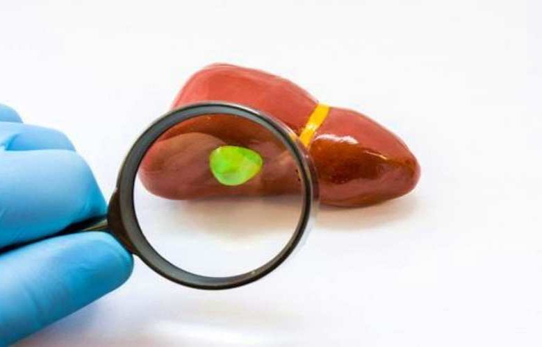 سلائل المرارة.. ما هي؟ ومتى يكون العلاج ضروريا؟