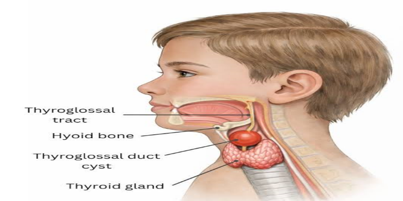 ما هي علامات وأعراض كيس الغدة الدرقية اللساني؟