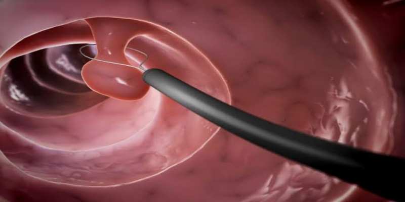 متى يكون العلاج ضرورياً لسلائل المرارة؟