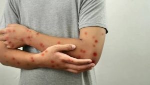 هل من الممكن أن يصاب البالغون بالحصبة ؟